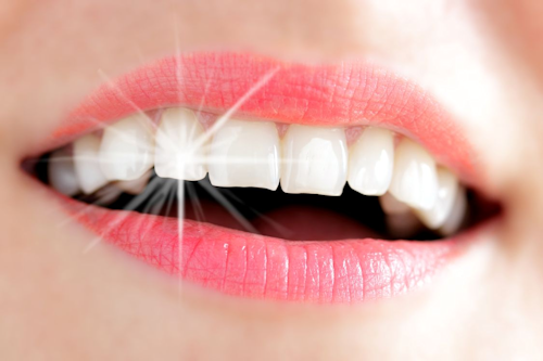 esthetique dentaire facettes lyon